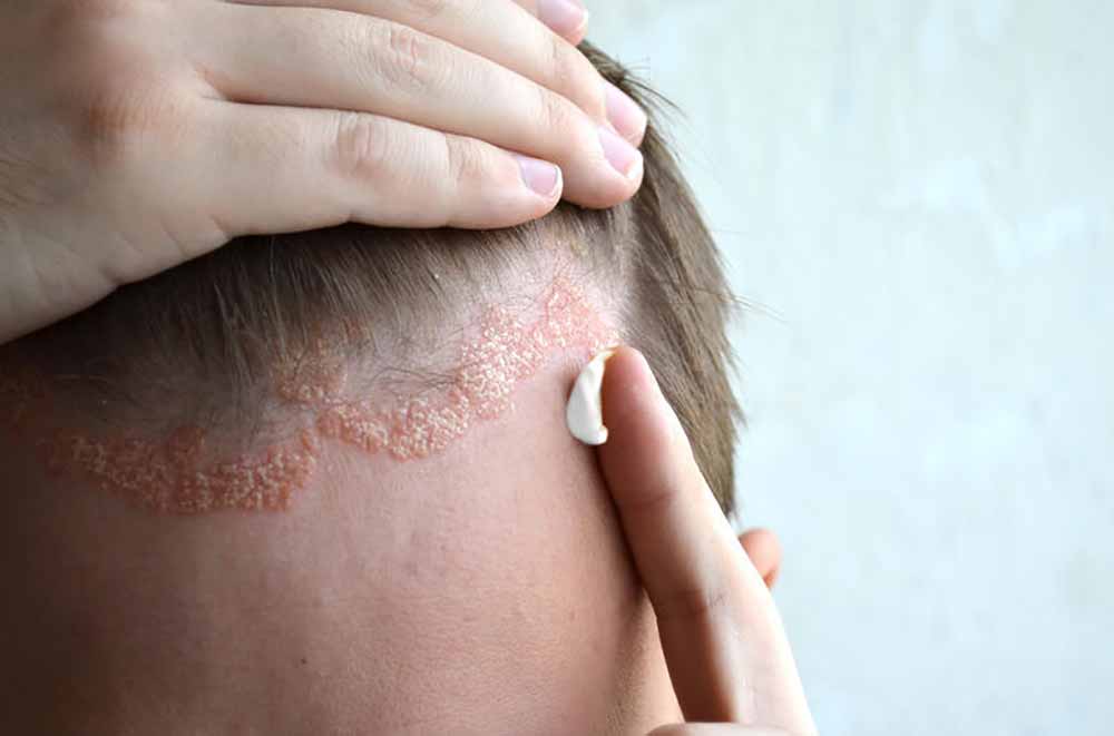 seboreični dermatitis